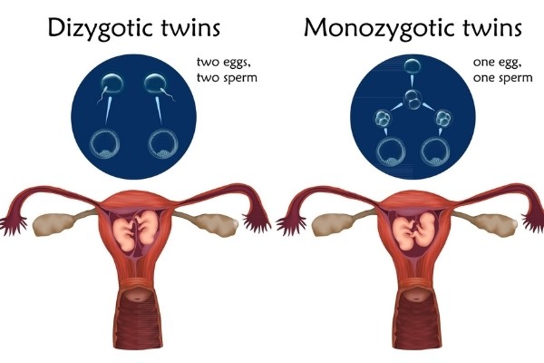 ฝาแฝดที่เหมือนกัน (Monozygotic) - ฝาแฝดที่ไม่เหมือนกัน (Dizygotic)
